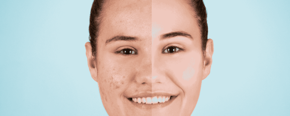 Professional Cosmetology Services - Hydra Facial, Acne Treatment, BB Glow Treatment in Satara.
